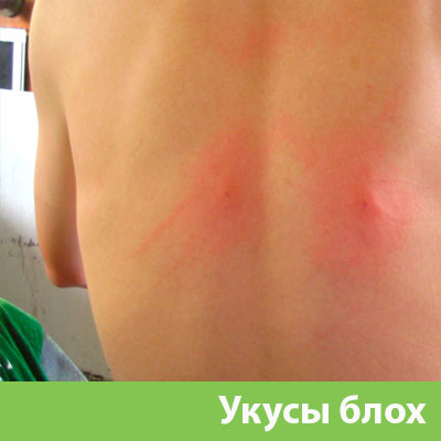 Укусы блох в Воткинске