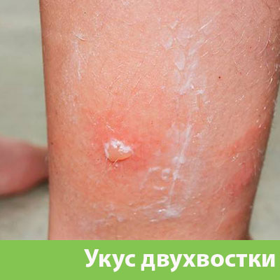 Укус двухвостки в Воткинске