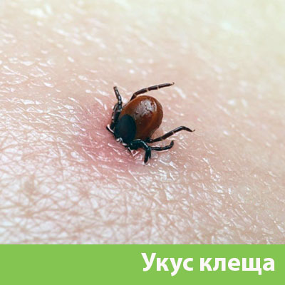 Укус клеща в Воткинске