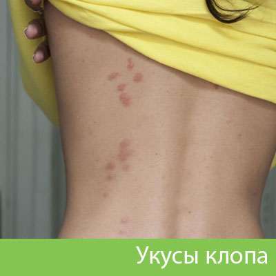 Профессиональное уничтожение клопов в Воткинске